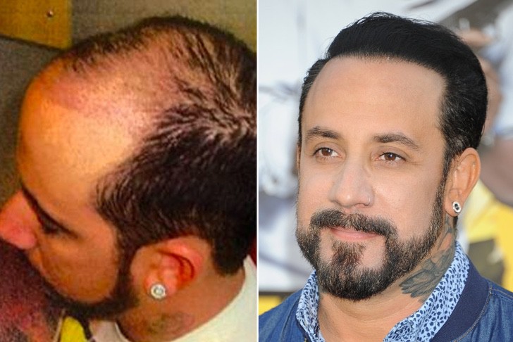 AJ McLean antes y después de su injerto de cabello
