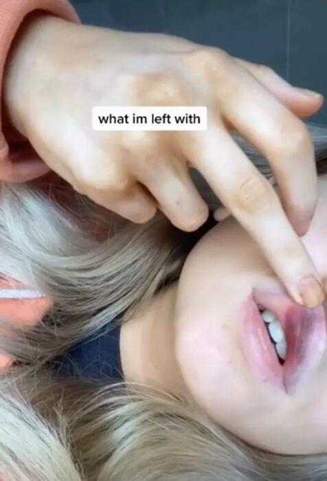 Chica mostrando los riesgos de rellenarse los labios