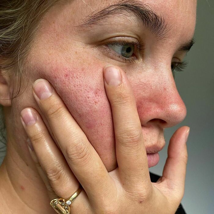 Chica de piel clara y ojos grises se toma selfie mostrando sus poros grandes en las mejillas