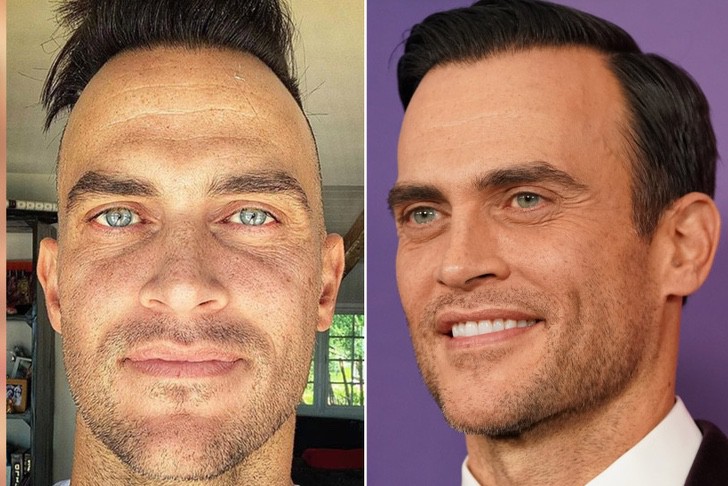 Cheyenne Jackson antes y después del injerto de cabello