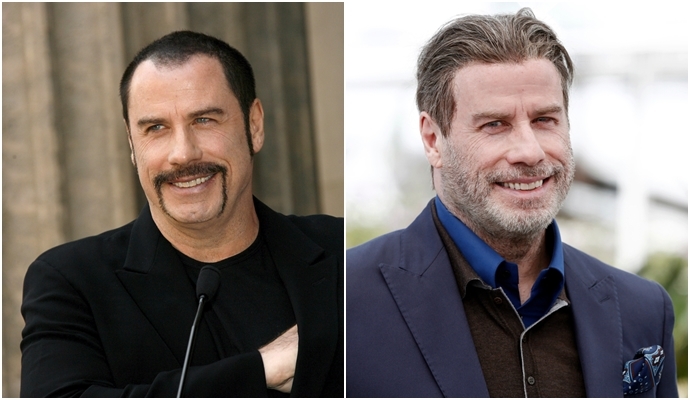John Travolta antes y después del injerto de cabello