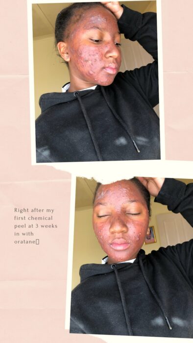 Chica negra con acné y peeling químico
