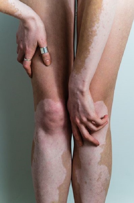 Piernas y brazos con vitiligio