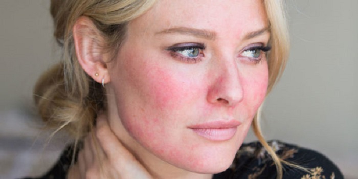 Mujer que padece rosacea