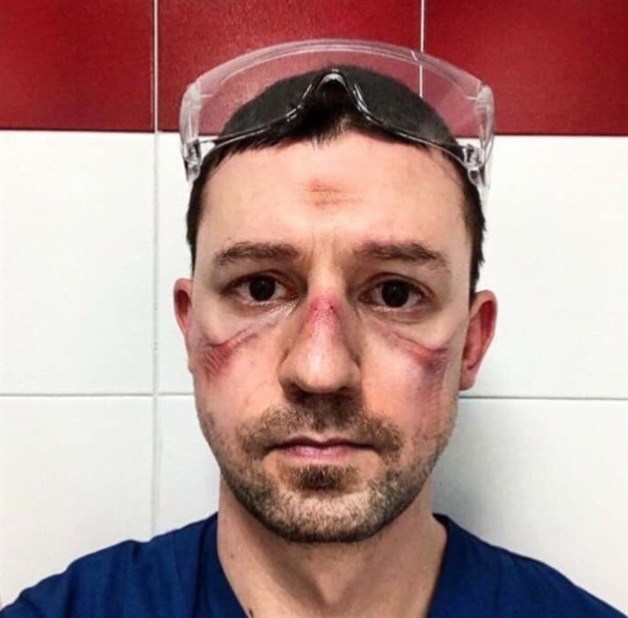 Médico con el rostro marcado por el uso de mascarillas especiales