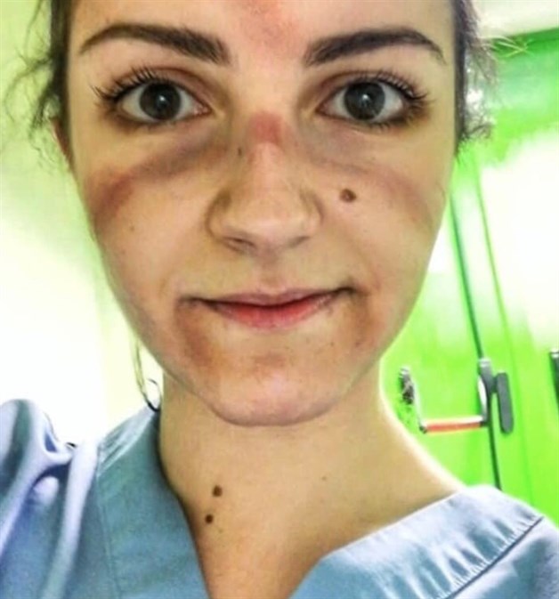 Mujer médico con el rostro marcado y amoratado por el uso de mascarillas especiales