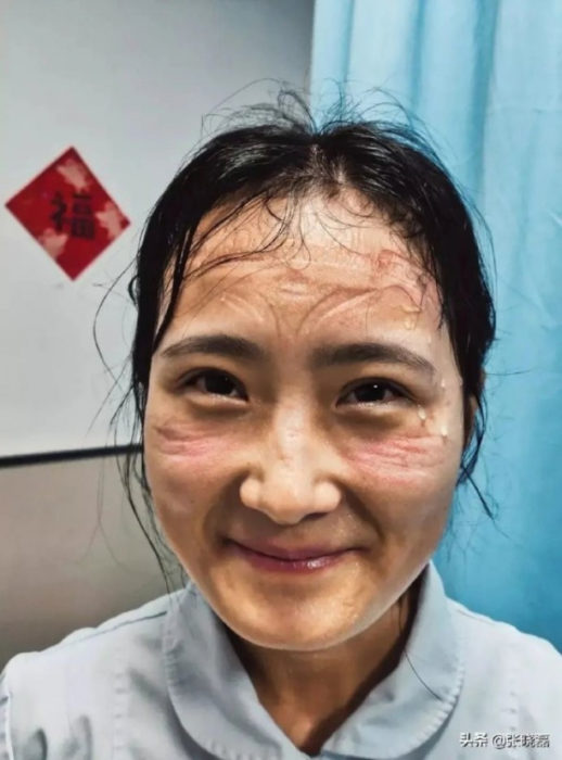 Mujer médico con el rostro marcado por el uso de mascarillas especiales