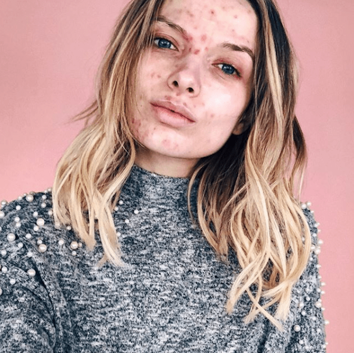 Chica de cabello rubio con brotes de acné en el rostro
